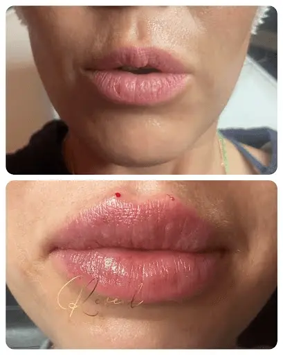 Lip Enhancement Before & After
