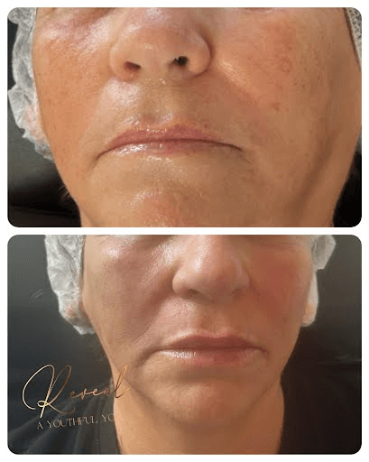 Lower Face Skin Improvement