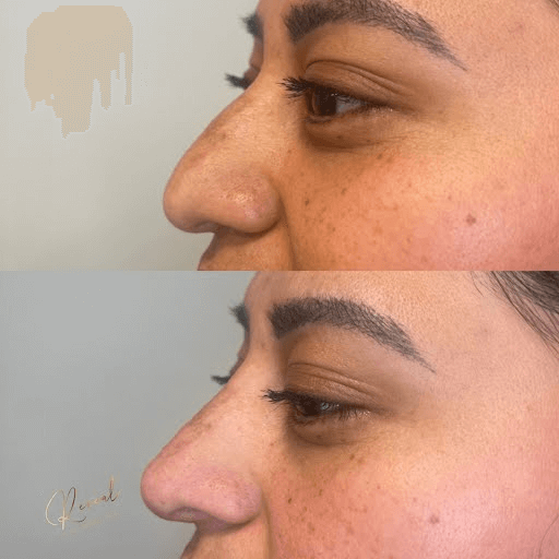 Nose Profile Before & After