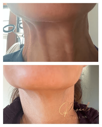 Neck Vein Transformation