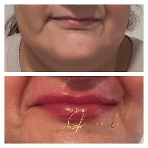 Lip Filler Before & After