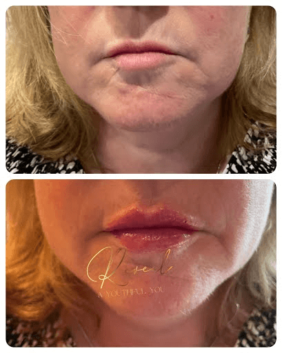 Lip Filler Before & After