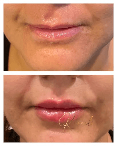 Lip Filler Before & After