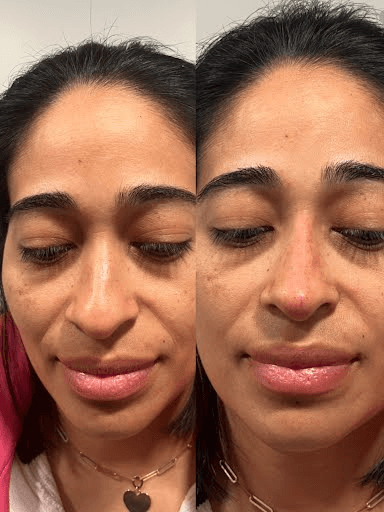 Skin Rejuvenation Before and After Results