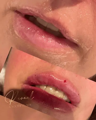 Plump & Perfect Lips Transformation