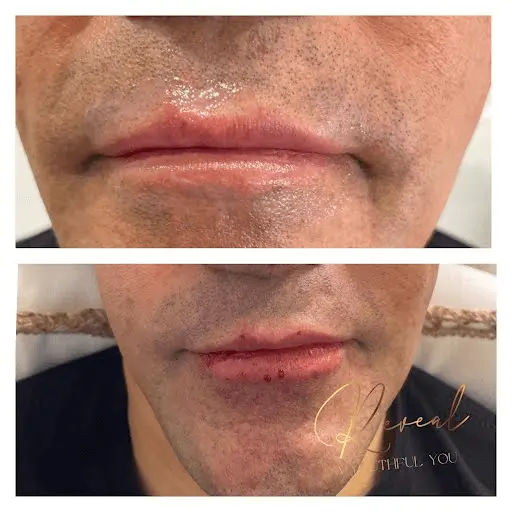 Lip Enhancement Before & After
