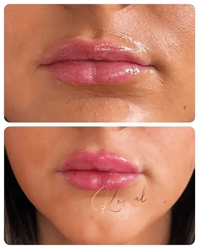 Lip Enhancement Before & After