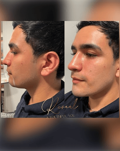 Face Enhancement Before & After