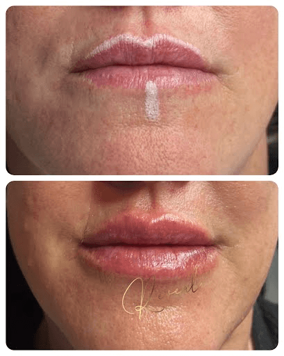 Lip Filler Results Before & After