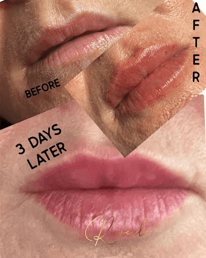 Lip Enhancement Before & After